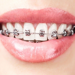 ارتودنسی دیمون