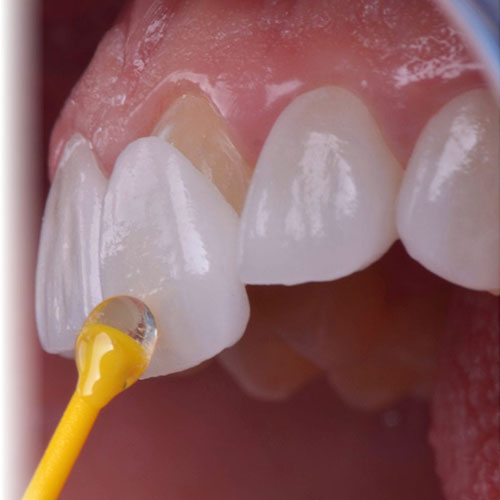 لمینت سرامیکی