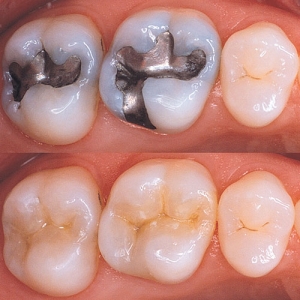 پر کردن دندان