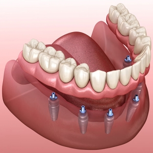 پروتز دندان ثابت