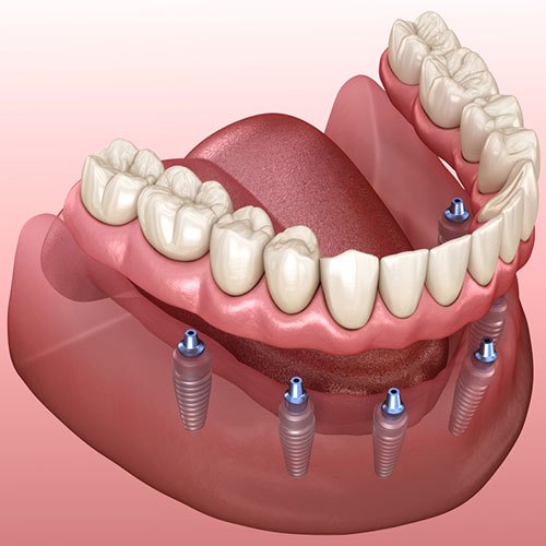 پروتز دندان ثابت
