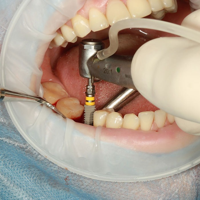 ایمپلنت دندان در فردیس