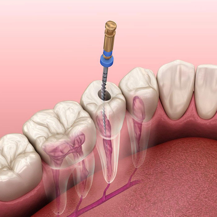 بخش تخصصی درمان ریشه دندان