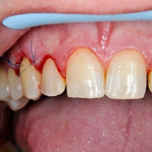 جراحی لثه در فردیس