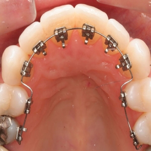 ارتودنسی لینگوال