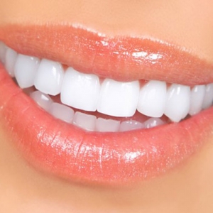 لمینت دندان بدون تراش