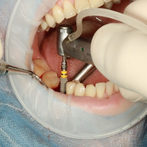 راهنمای پیش از جراحی ایمپلنت دندان