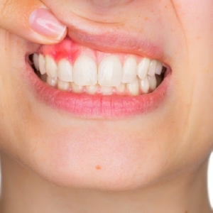علت درد لثه و درمان