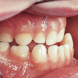مال اکلوژن دندان چیست ؟