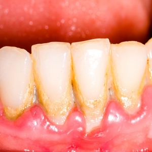 پلاک دندان چیست؟