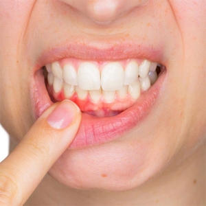 آبسه دندان چگونه به وجود می آید؟