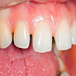 دیاستما یا فاصله بین دندانی چیست؟