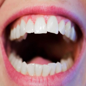 علت کج شدن دندان ها چیست؟