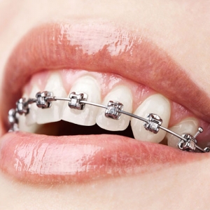 چگونه از بریس های خود مراقبت کنیم؟