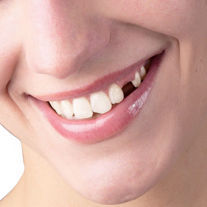 انواع روش جایگزین کردن دندان کشیده