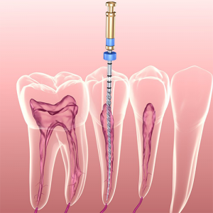 علت انجام عصب کشی دندان