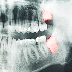 کشیدن به موقع دندان عقل