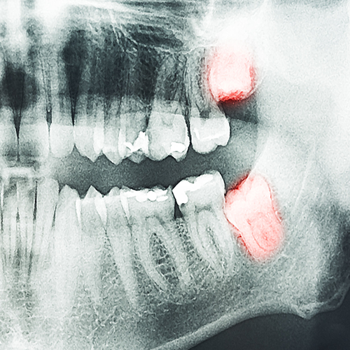کشیدن به موقع دندان عقل