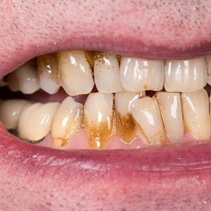 دلایل تغییر رنگ دندان ها چیست؟