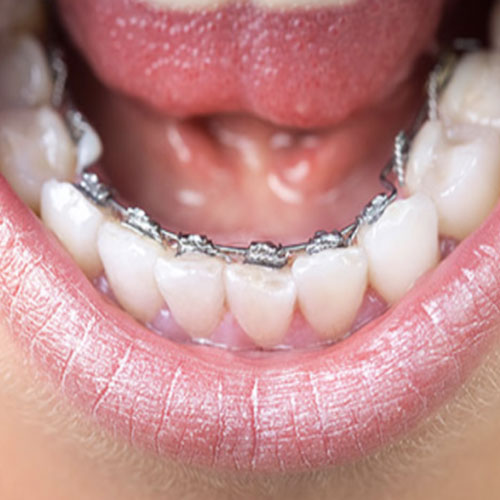 ارتودنسی مخفی چیست؟