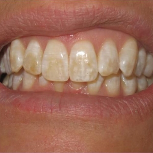 مینای دندان و عارضه هیپوپلازی