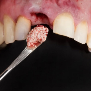 پیوند استخوان فک