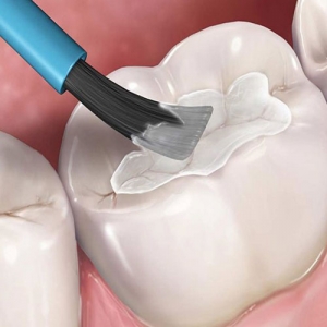 سیلانت دندان چیست؟