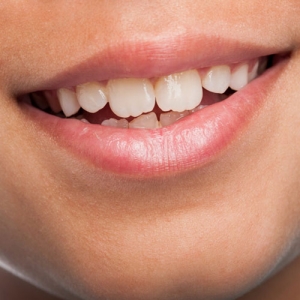 ماملون دندان چیست؟