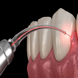 کاربرد لیزر دندانپزشکی چیست؟