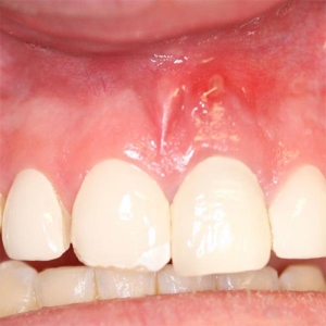 آبسه دندان، علل، علائم و درمان