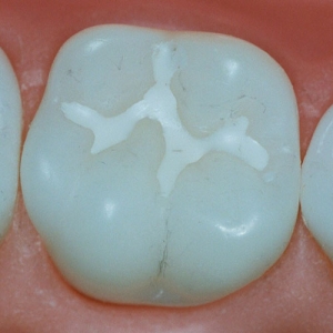 فیشورسیلانت چیست؟