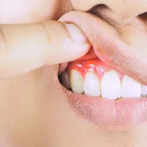 پریودانتیکس چیست؟